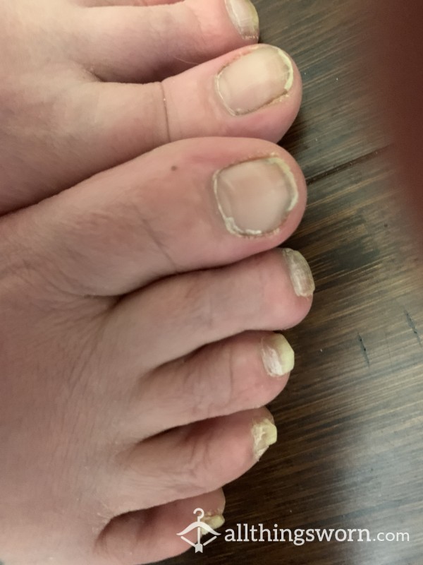 10 Feet Toe & Sole Pics Pictures Of My Unpedicured Feet Soles Nails