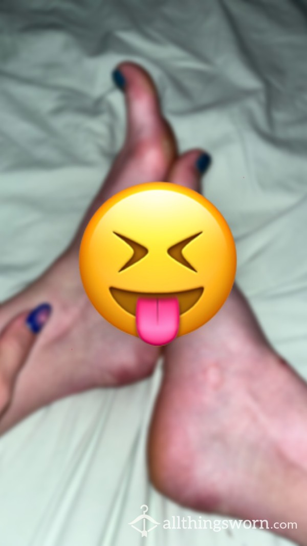 5 PICS Rough Calloused Feet With Blisters Size 7 | Light Blue Toe Polish | Athlete Feet