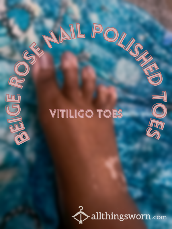 8 Beige Rose Nail Polished Toes|vitiligo Toes