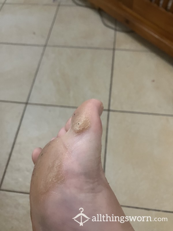 Big Wide Foot Foot Peel Progression