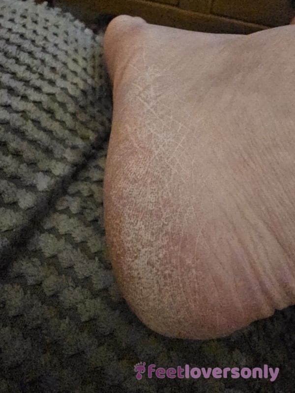 Dry Cracked Heels