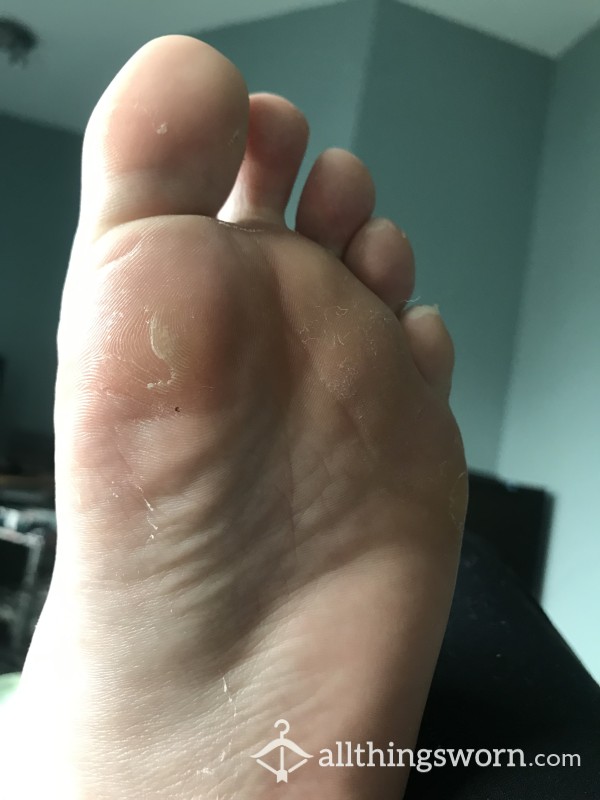Foot Peel, Flaky Skin- Fresh From A Foot Peel