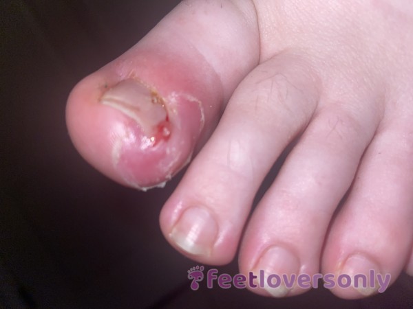 Icky Infected Toe With Hair