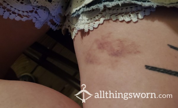 Pictures Of My Impact Play Bruises